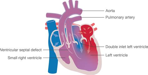 double inlet left ventricular